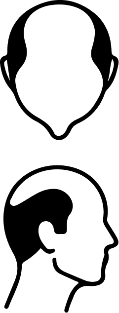 Norwood-Stufe 5 – schematische Darstellung