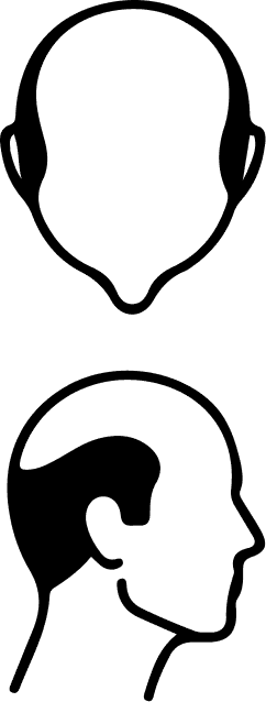 Norwood-Stufe 6 – schematische Darstellung